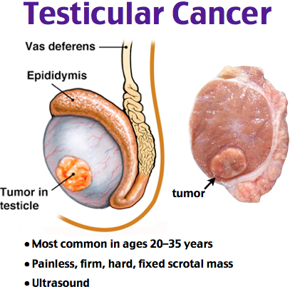 Testicular Cancer | Causes, Symptoms & Treatments | Cancer Council