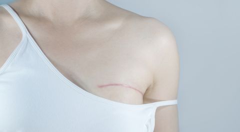 Nipple and Areola Reconstruction: Restoring Appearance - Leif